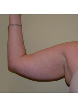 Arm Lift before at Woodbury Plastic Surgery, David Thao, MD in Woodbury, MN