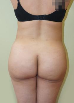 Liquid BBL after at Woodbury Plastic Surgery, David Thao, MD in Woodbury, MN