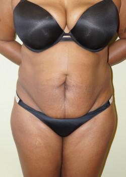 Mini Tummy Tuck before at Woodbury Plastic Surgery, David Thao, MD in Woodbury, MN