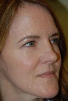 Blepharoplasty after at Woodbury Plastic Surgery, David Thao, MD in Woodbury, MN