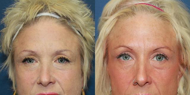 Brow Lift result at Gallas Plastic Surgery in Houston, TX