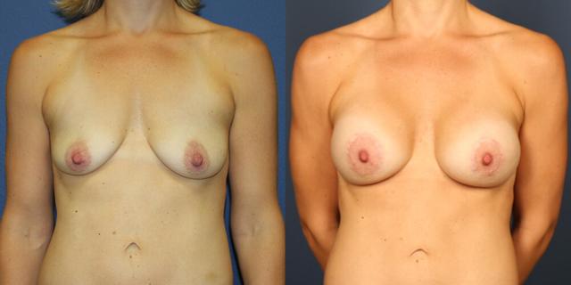 Breast Lift result at Gallas Plastic Surgery in Houston, TX