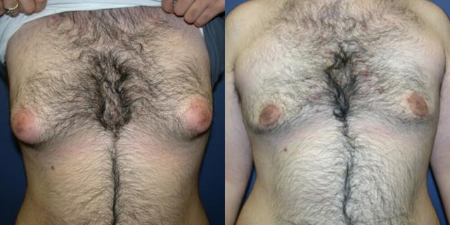Gynecomastia Surgery result at Gallas Plastic Surgery in Houston, TX