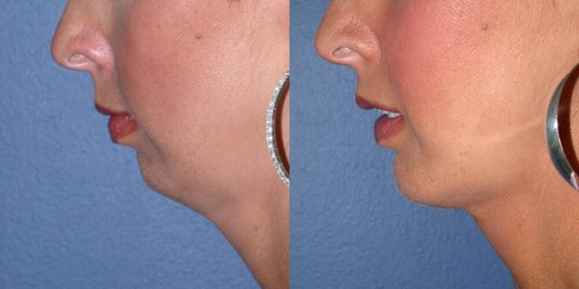 Chin Implant result at Gallas Plastic Surgery in Houston, TX