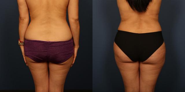 Fat Transfer result at Gallas Plastic Surgery in Houston, TX