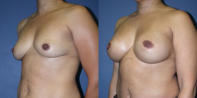 Breast Augmentation result at Gallas Plastic Surgery in Houston, TX