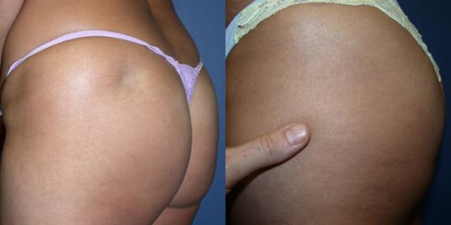 Fat Transfer result at Gallas Plastic Surgery in Houston, TX