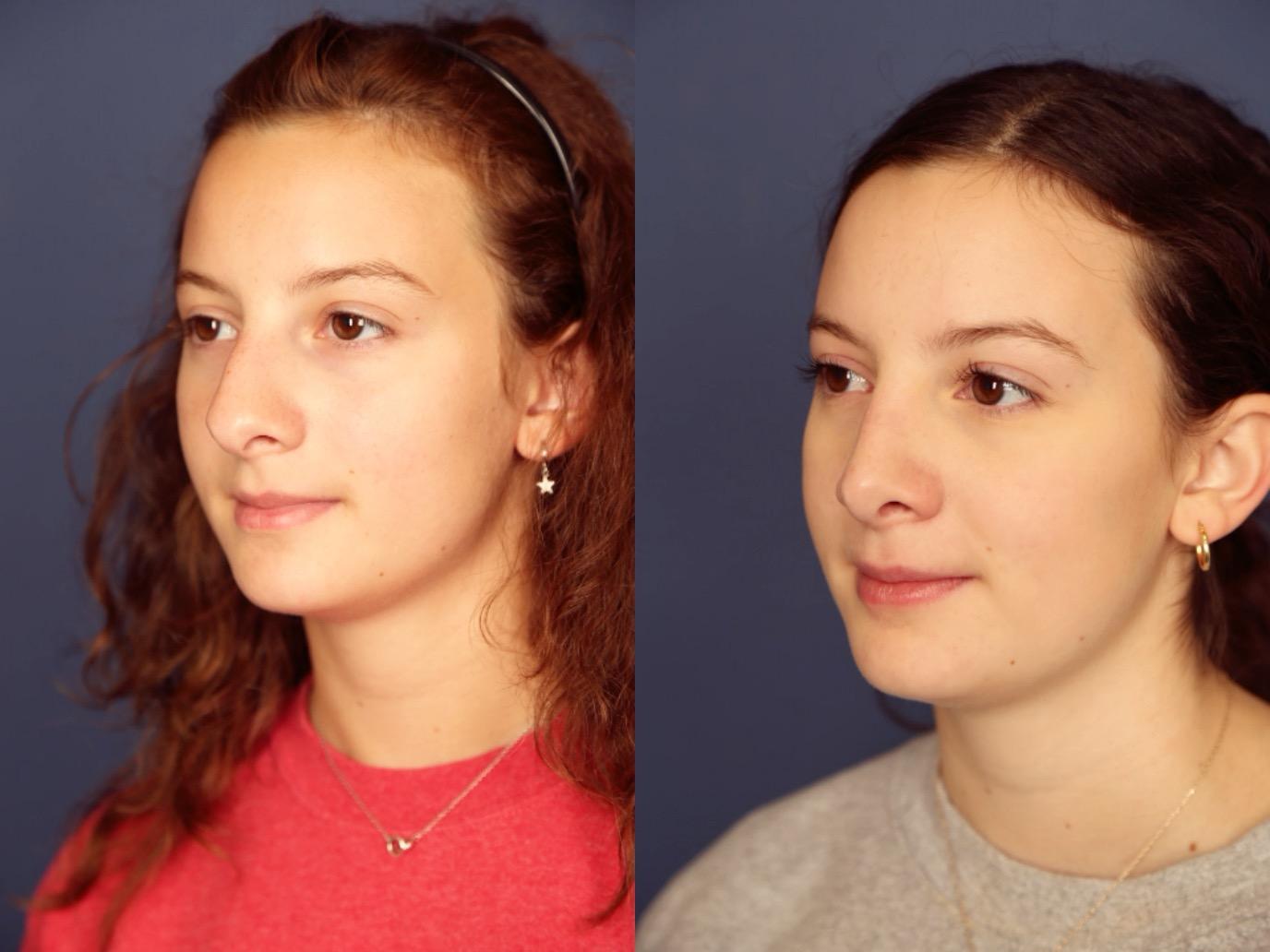 Gallas Plastic Surgery rhinoplasty result — Houston, TX