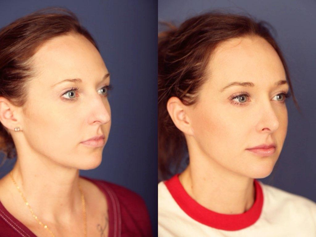 Gallas Plastic Surgery rhinoplasty result — Houston, TX