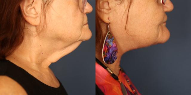 Neck Lift result at Gallas Plastic Surgery in Houston, TX