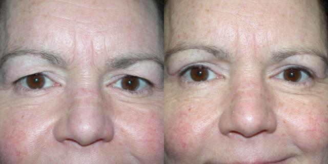 Blepharoplasty result at Gallas Plastic Surgery in Houston, TX