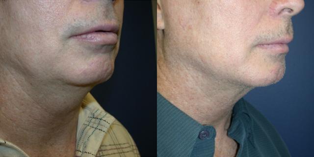 Chin Implant result at Gallas Plastic Surgery in Houston, TX