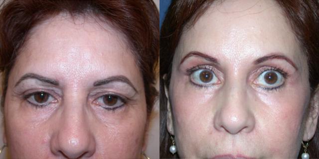 Brow Lift result at Gallas Plastic Surgery in Houston, TX