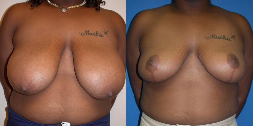 Gallas Plastic Surgery breast reduction result — Houston, TX