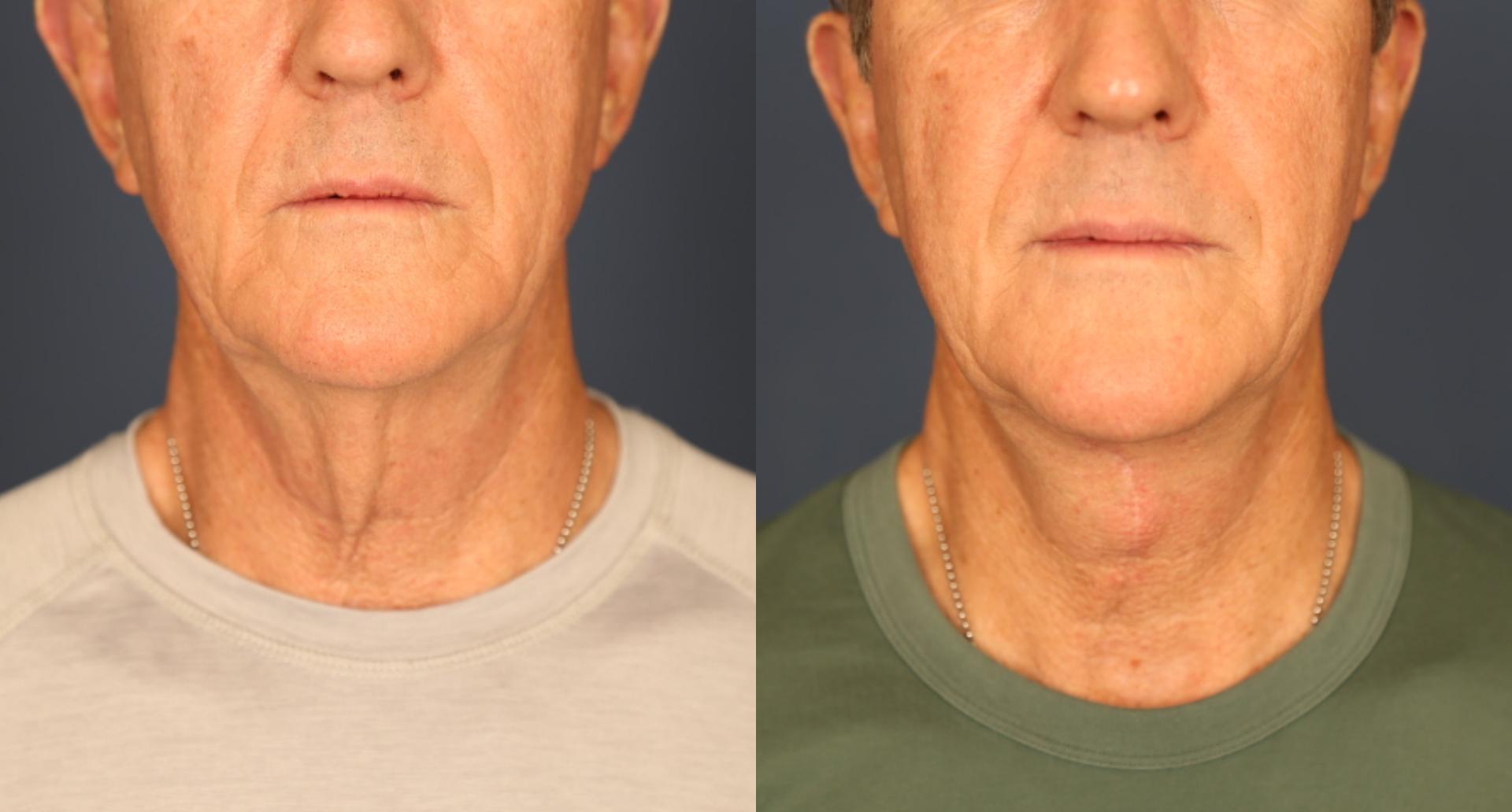 Gallas Plastic Surgery neck lift result — Houston, TX