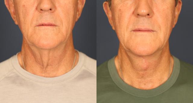 Neck Lift result at Gallas Plastic Surgery in Houston, TX