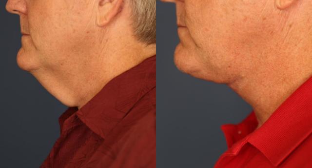 Neck Lift result at Gallas Plastic Surgery in Houston, TX