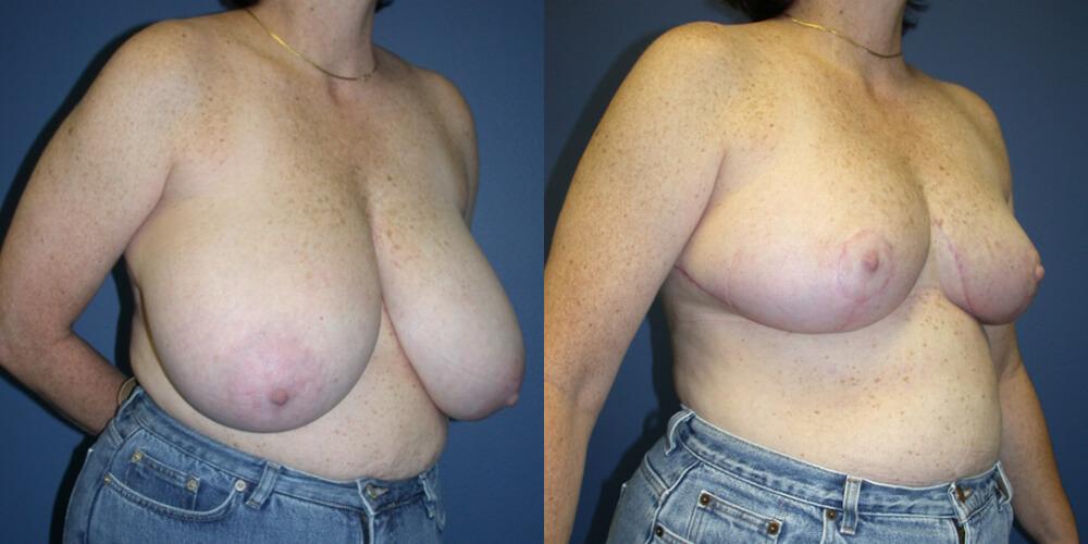 Gallas Plastic Surgery breast reduction result — Houston, TX