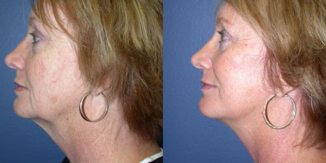 Facelift result at Gallas Plastic Surgery in Houston, TX