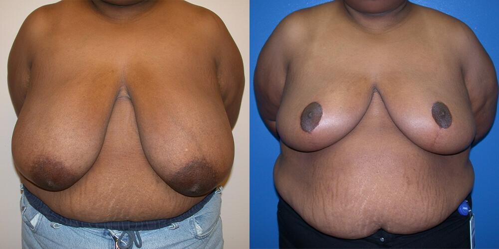 Gallas Plastic Surgery breast reduction result — Houston, TX