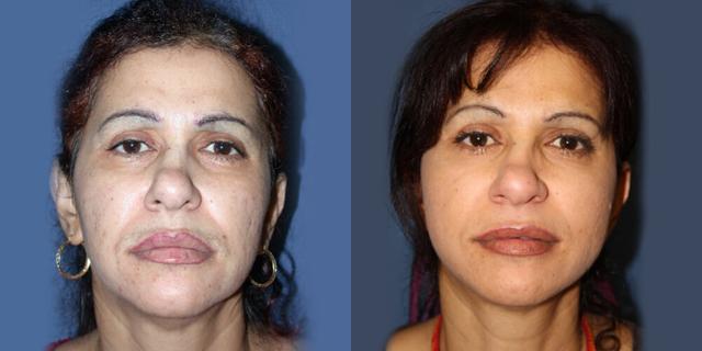 Fat Transfer result at Gallas Plastic Surgery in Houston, TX