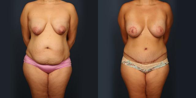 Mommy Makeover result at Gallas Plastic Surgery in Houston, TX