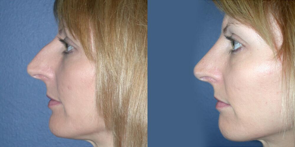 Gallas Plastic Surgery rhinoplasty result — Houston, TX