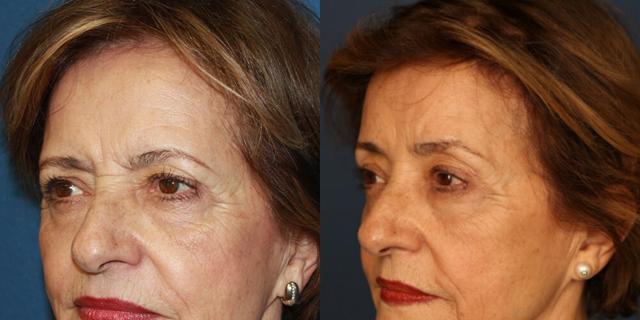 Brow Lift result at Gallas Plastic Surgery in Houston, TX