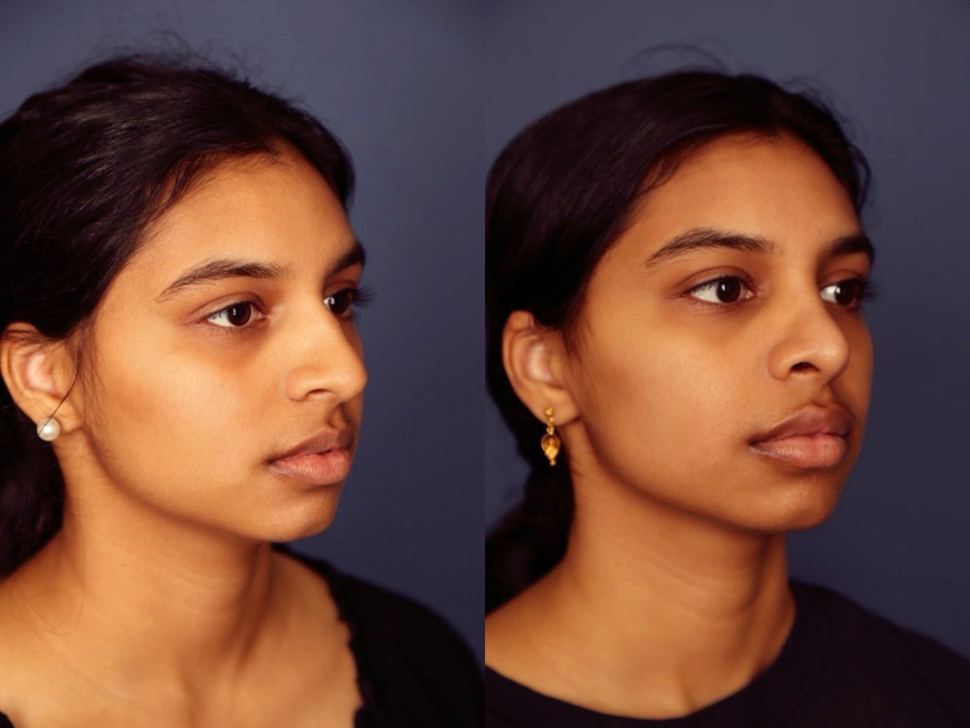 Gallas Plastic Surgery rhinoplasty result — Houston, TX