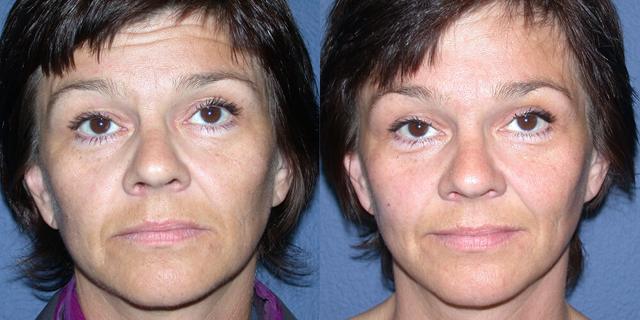 Brow Lift result at Gallas Plastic Surgery in Houston, TX
