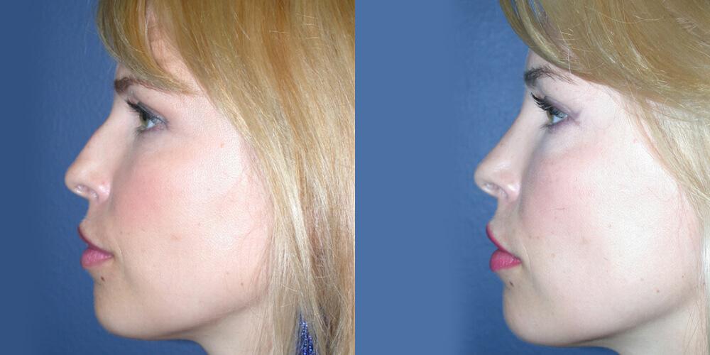 Gallas Plastic Surgery rhinoplasty result — Houston, TX