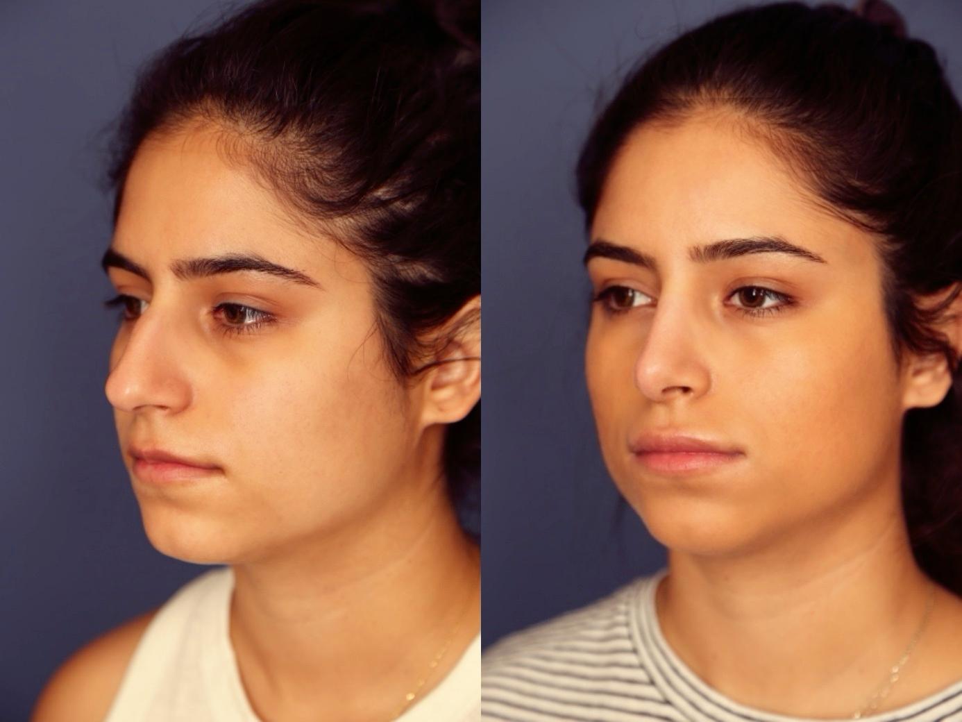 Gallas Plastic Surgery rhinoplasty result — Houston, TX