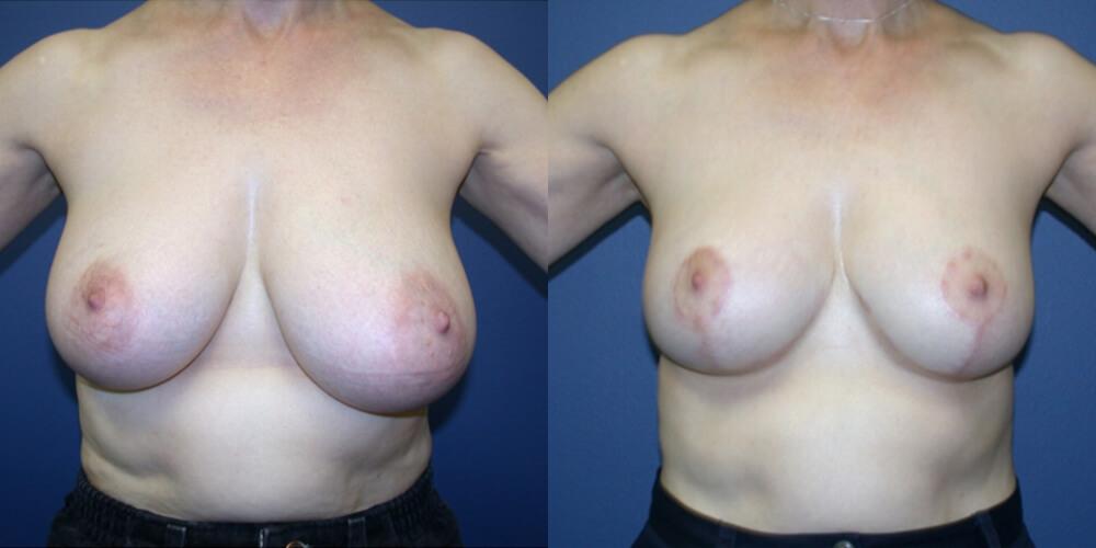 Gallas Plastic Surgery breast reduction result — Houston, TX