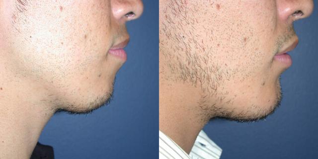 Chin Implant result at Gallas Plastic Surgery in Houston, TX
