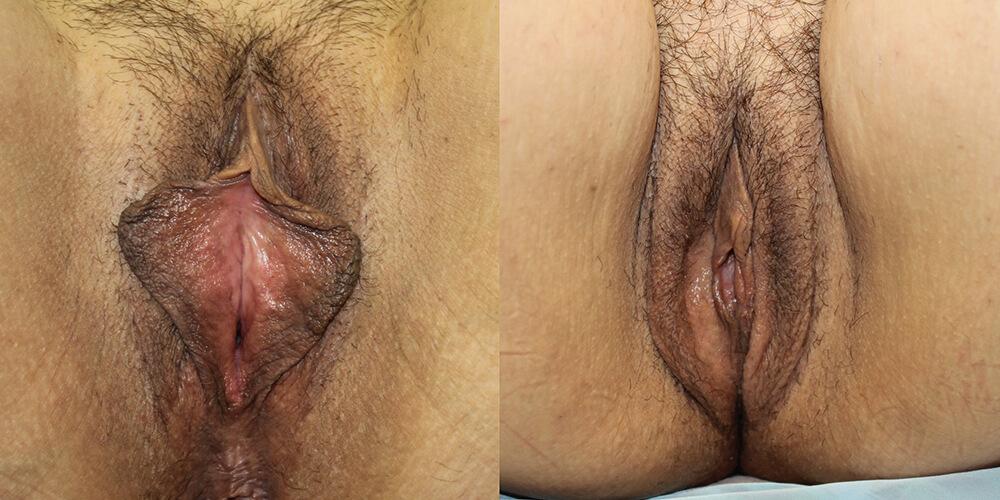 Gallas Plastic Surgery labiaplasty result — Houston, TX