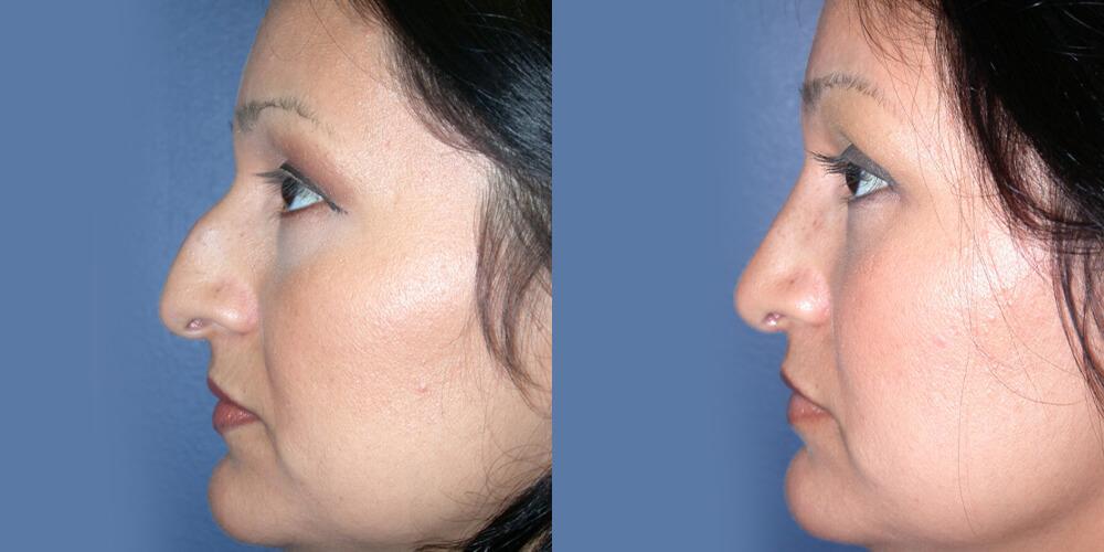 Gallas Plastic Surgery rhinoplasty result — Houston, TX