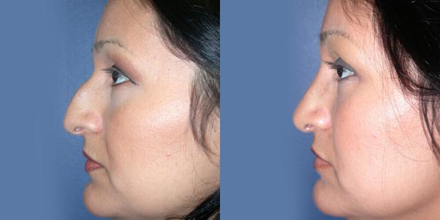 Liquid Rhinoplasty result at Gallas Plastic Surgery in Houston, TX