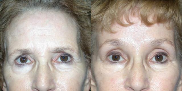 Brow Lift result at Gallas Plastic Surgery in Houston, TX