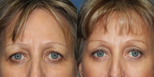 Brow Lift result at Gallas Plastic Surgery in Houston, TX