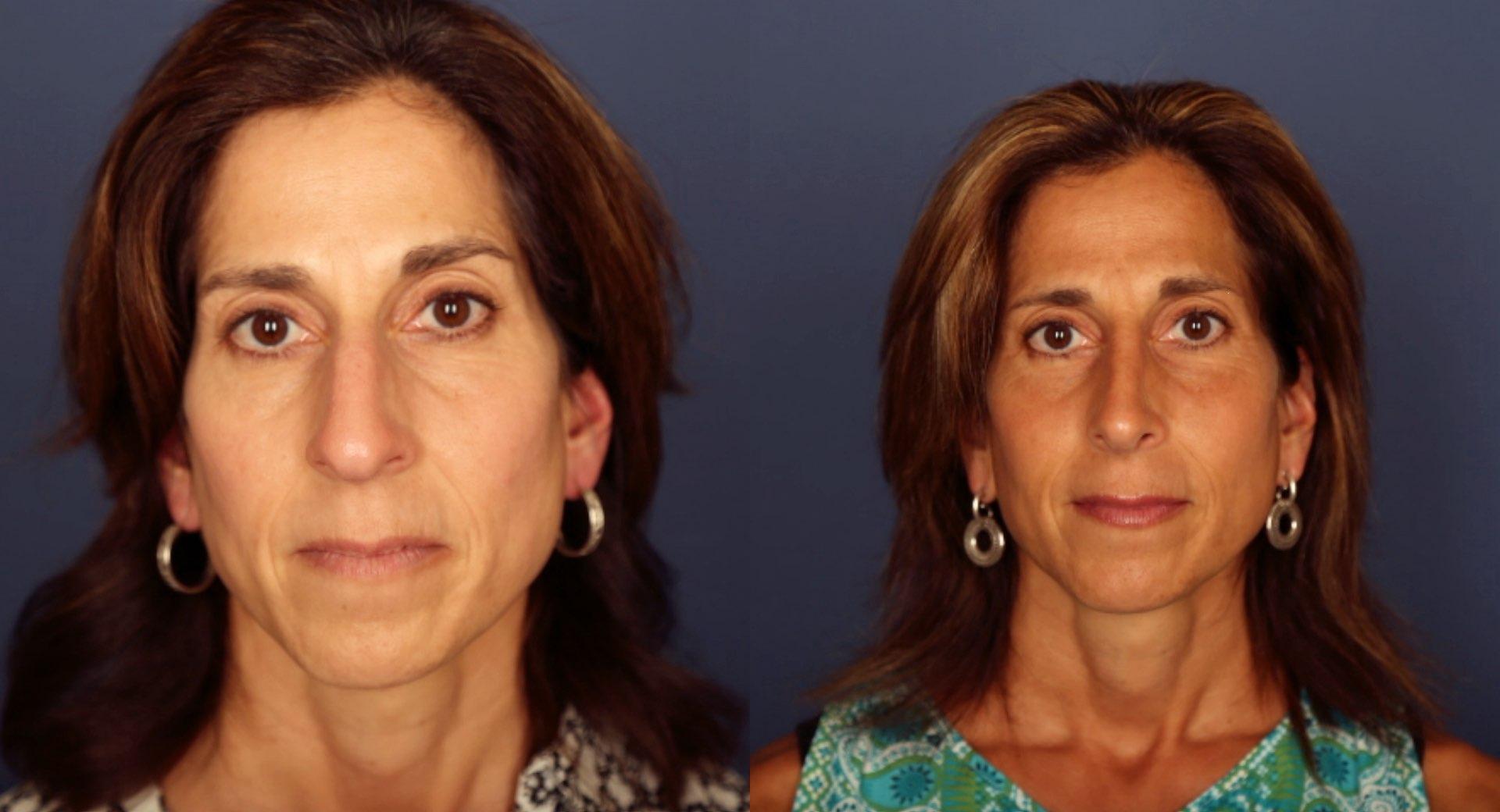 Gallas Plastic Surgery rhinoplasty result — Houston, TX