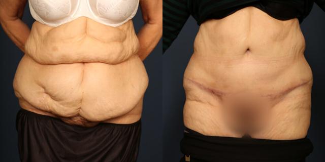 Mini Tummy Tuck result at Gallas Plastic Surgery in Houston, TX