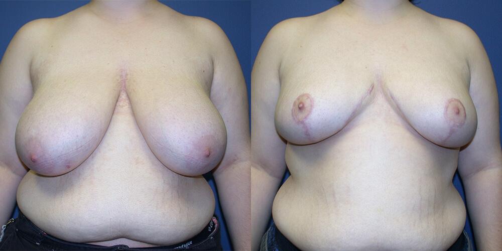 Gallas Plastic Surgery breast reduction result — Houston, TX