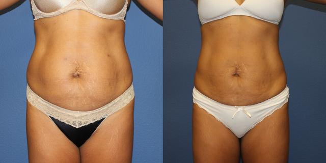 Liposuction result at Gallas Plastic Surgery in Houston, TX