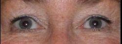 John Lee, MD Eyelid Surgery & Med Spa eyelid lift after — Bryn Mawr, PA