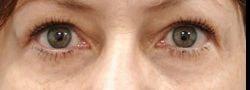 John Lee, MD Eyelid Surgery & Med Spa eyelid lift after — Bryn Mawr, PA