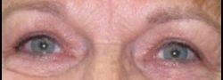 John Lee, MD Eyelid Surgery & Med Spa eyelid lift after — Bryn Mawr, PA
