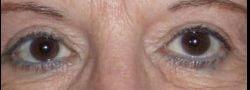 John Lee, MD Eyelid Surgery & Med Spa eyelid lift after — Bryn Mawr, PA