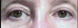 John Lee, MD Eyelid Surgery & Med Spa eyelid lift after — Bryn Mawr, PA