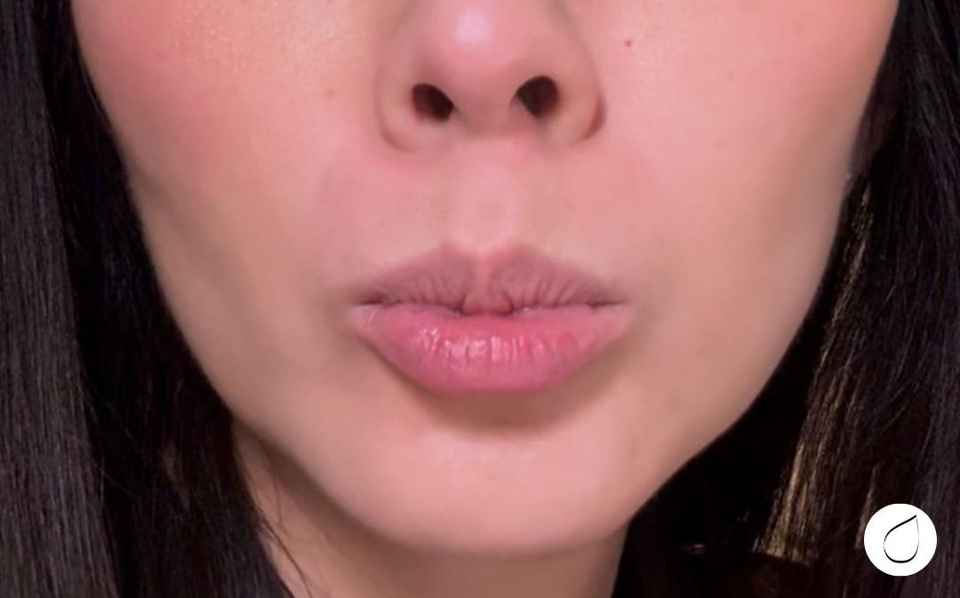 Dewy Aesthetics botox after — New York, NY