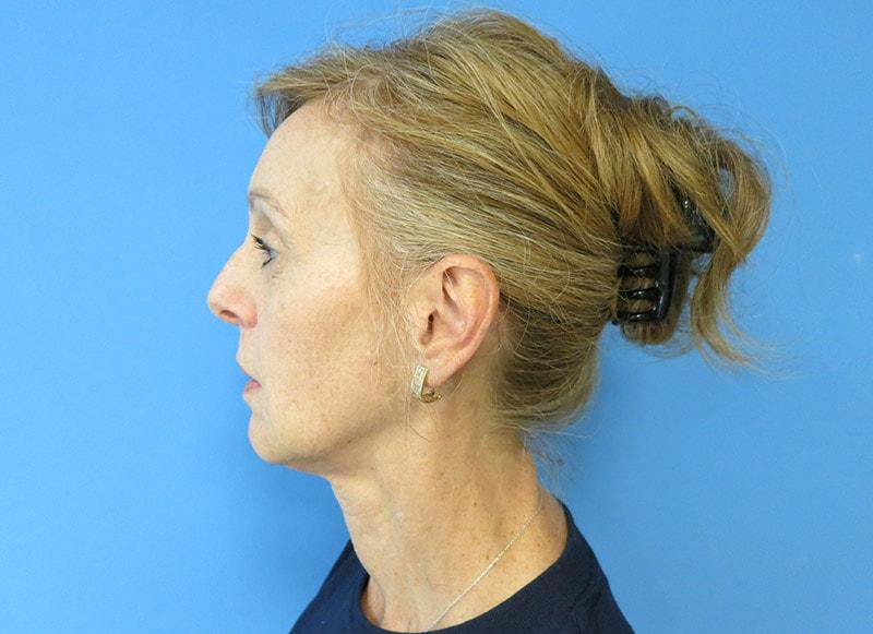 Neil Tanna, MD, FACS cheek filler after — Great Neck, NY